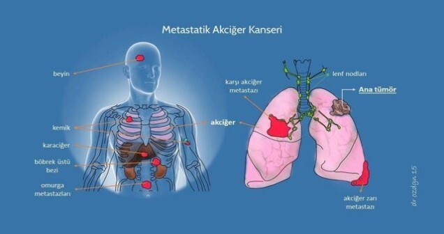 4. Evre Kanser Nedir, Metastaz Ve Metastatik Nedir, Metastaz Belirtileri, Kanser Neden Metastaz Yapar?